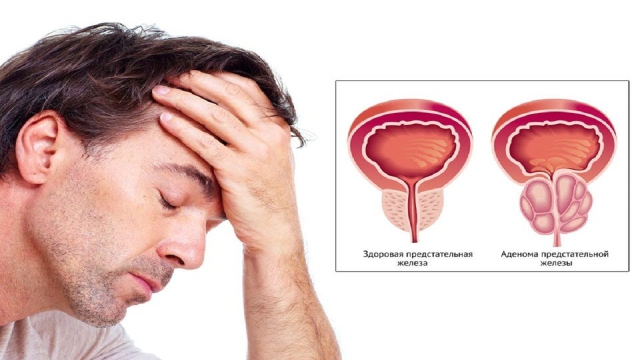Симптомы аденомы простаты у мужчин и лечение
