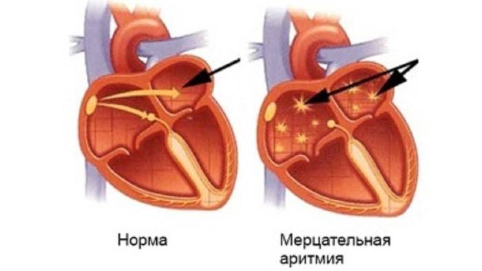 Аритмия сердца