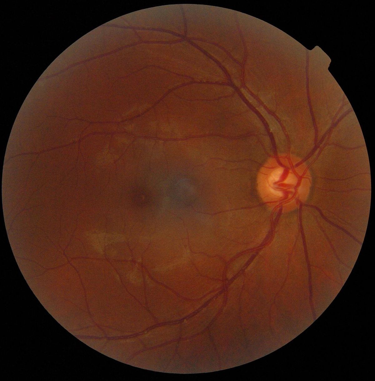 Заболевания сетчатой оболочки глаза (сетчатки). диагностика и лечение