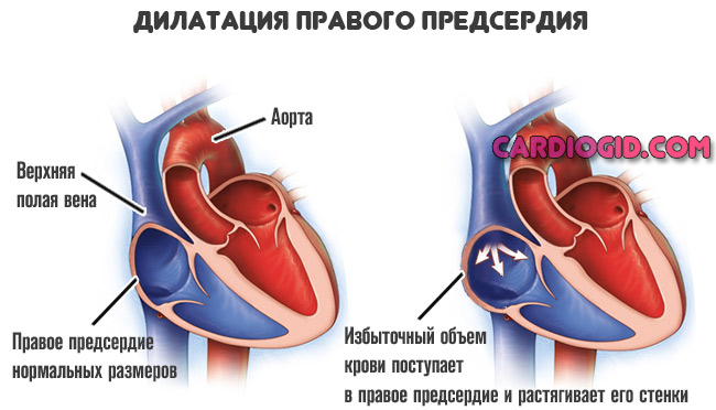 Дилатация левого предсердия: что это такое и как лечить? — сердце