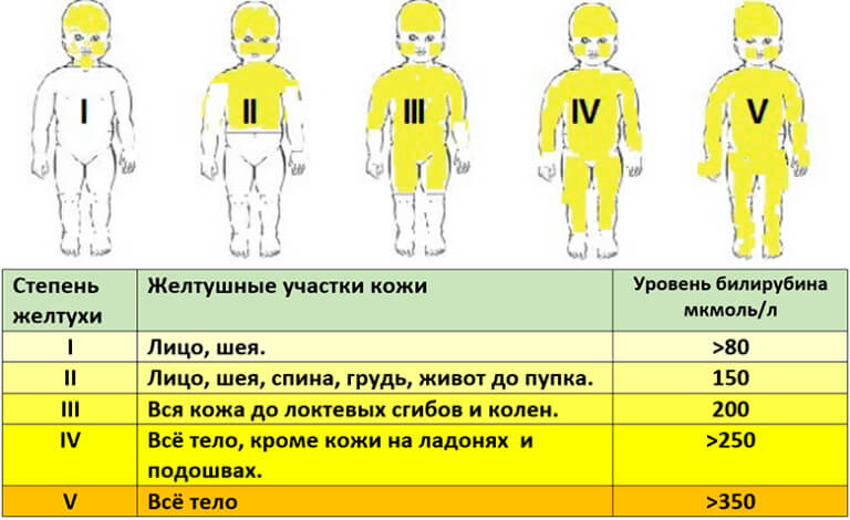 Механическая желтуха у новорожденных: причины и лечение