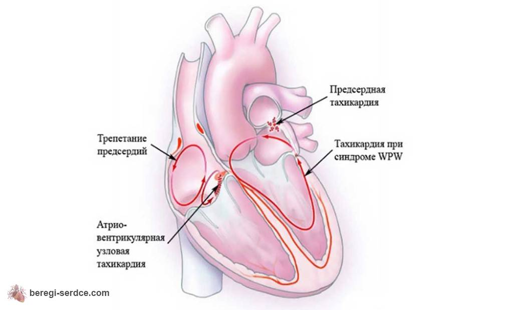 Тахикардия - как лечить тахикардию сердца, симптомы и разновидности