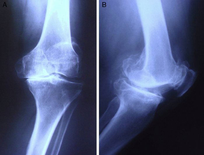 Артроз коленного сустава 1 степени: лечение, причины, симптомы заболевания
