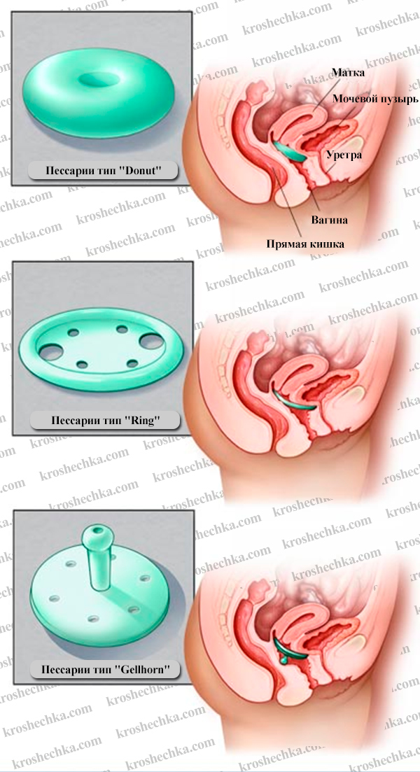 Кольцо для беременных или акушерский пессарий: показания к использованию