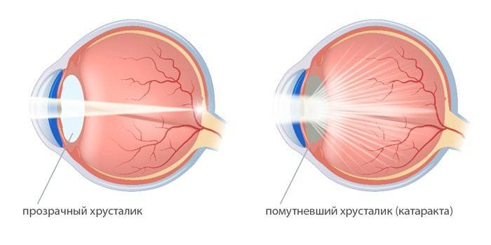 Почему катаракта так опасна и как от неё избавиться