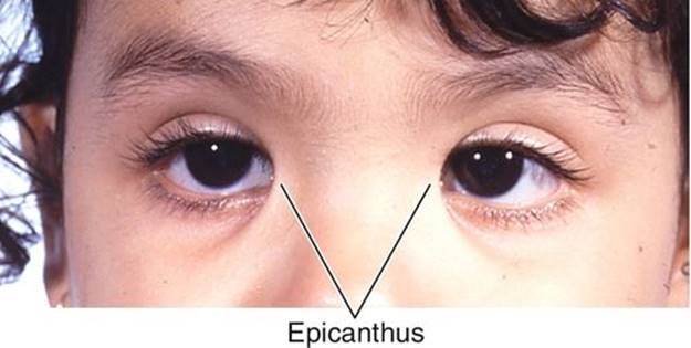 Эпикантус: что это такое, характерные признаки у монголоидной расы, наличие складки у ребенка, лечение, профилактика, осложнение