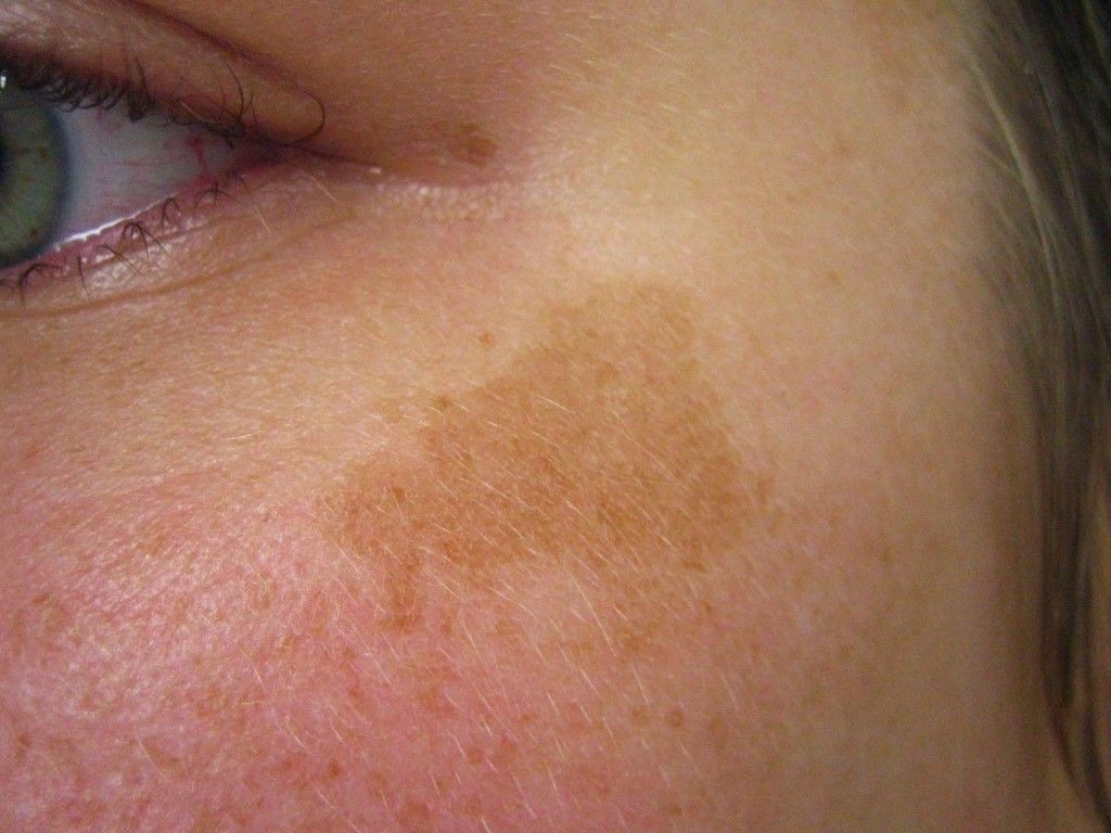 Пигментные пятна - лечение и причины пигментации, что это такое гиперпигментация кожи лица, почему появляются пигменты у женщин