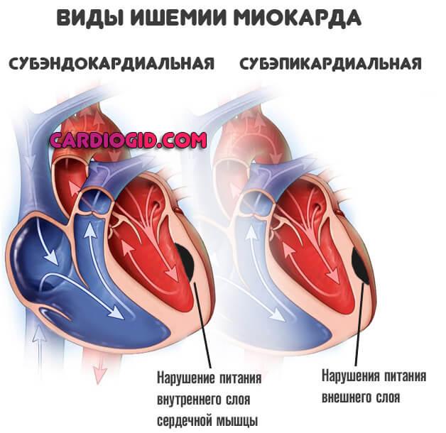 Причины митральной регургитации 1-4 степени, как выявить проблему и способы лечения