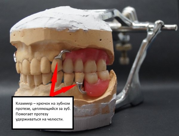 Бюгельный зубной протез:достоинства, недостатки, отзывы, особенности применения