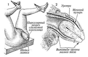 Что такое гистерэктомия матки: методы гинекологического вмешательства