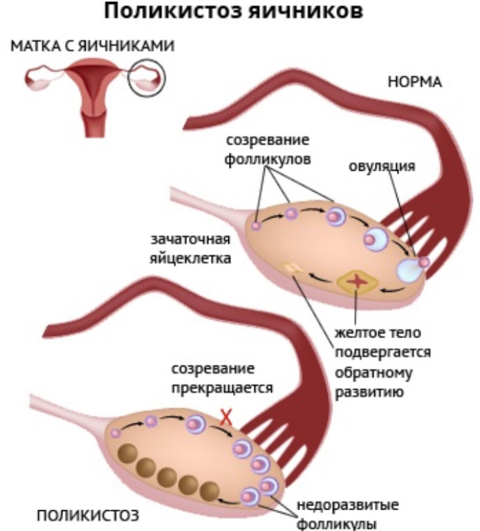 Симптомы и лечение синдрома поликистозных яичников