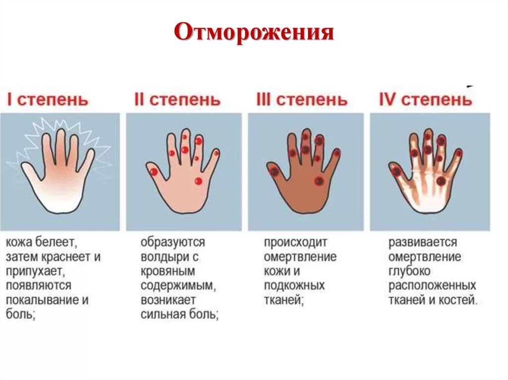 Степени обморожения картинки