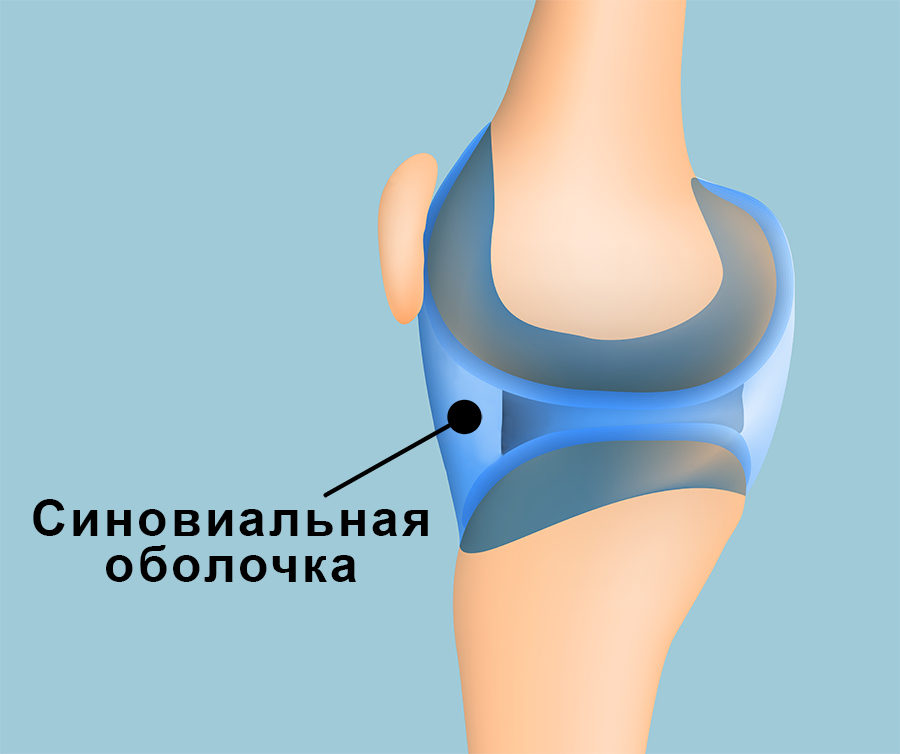 Синовит коленного сустава - симптомы лечение патологии
