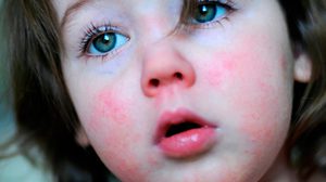 Симптомы и лечение скарлатины у детей