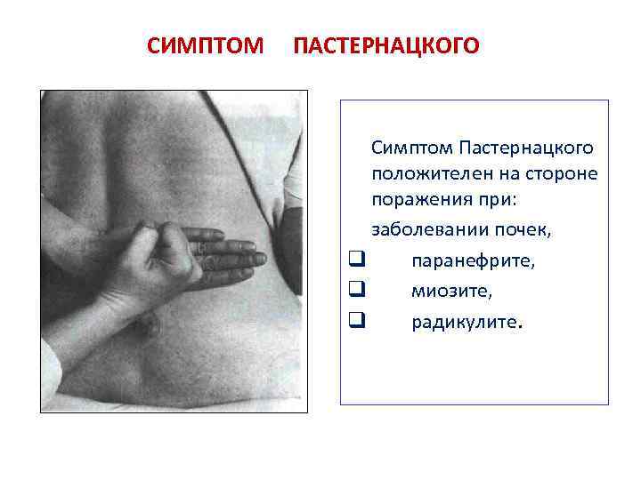 Симптом пастернацкого: факторы, диагностика, терапия - нет заразе