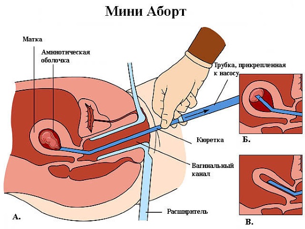 Анэмбриония: причины, симптомы и лечение