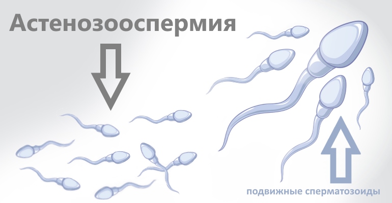Астенозооспермия: что это такое, лечение медленных сперматозоидов, препараты и отзывы