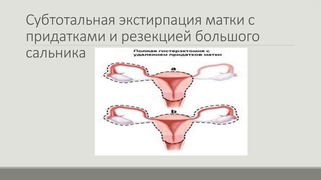 Методы удаления матки: виды гистерэктомии