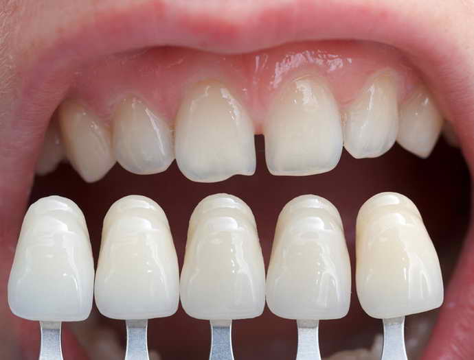 Что такое виниры для зубов