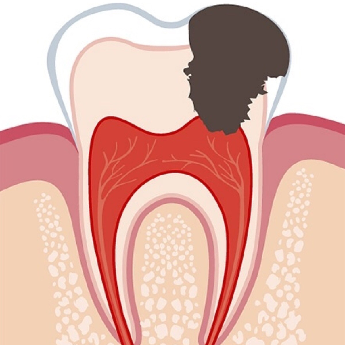 Пульпит зуба: что это такое, причины появления, диагностика и лечение | rvdku.ru