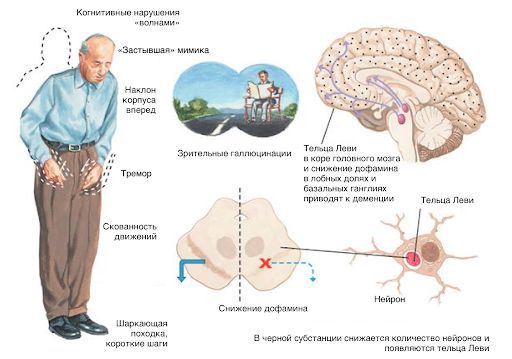 Ишемическая болезнь сосудов головного мозга - симптомы и причины