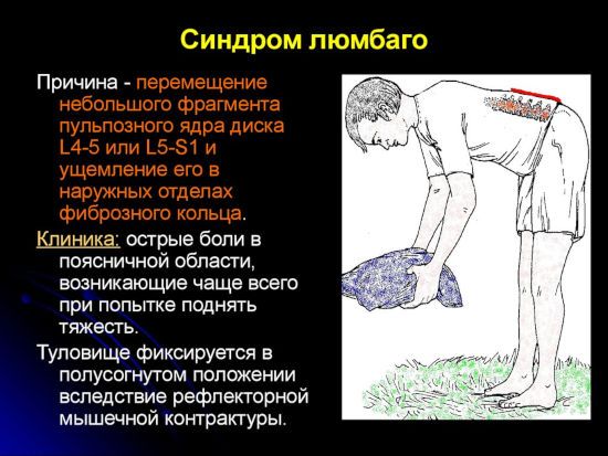 Дорсопатия поясничного отдела позвоночника