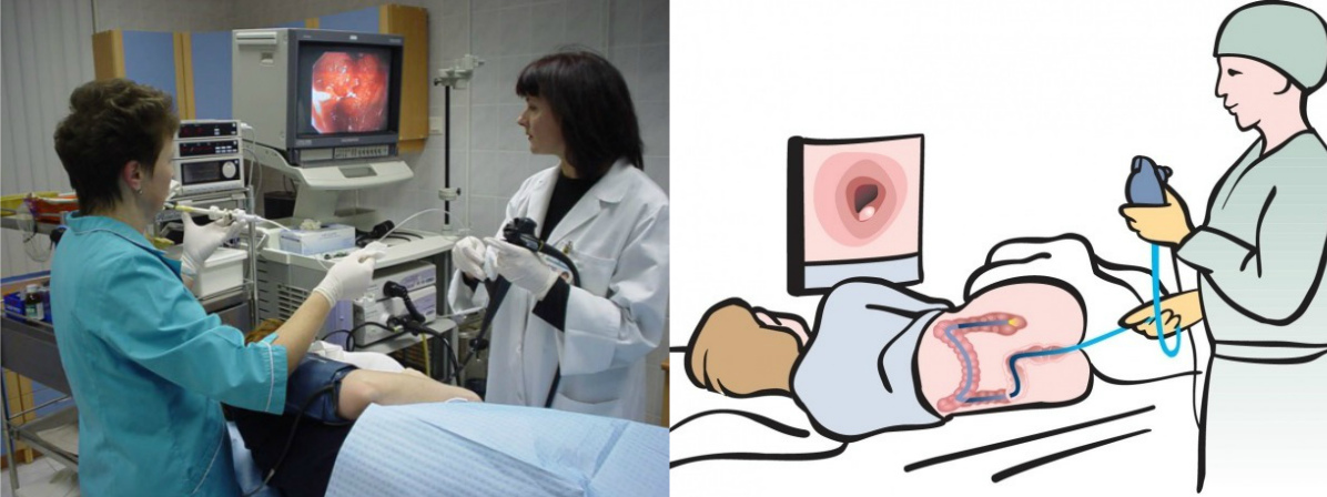 Женщины у проктолога видео. Аноскопия и ректороманоскопия что это. Ректоскопия кишечника. Ректоскопия, ректороманоскопия, колоноскопия.