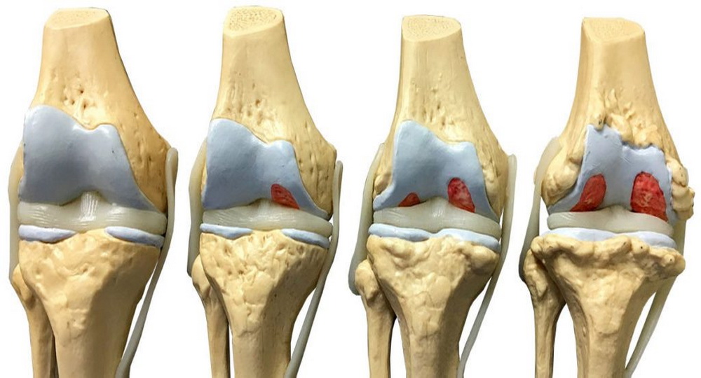 Гонартроз коленного сустава 3-4 степени: перспективы лечения