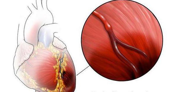 Ишемические болезни сердца: причины, симптомы, диагностика и лечение
