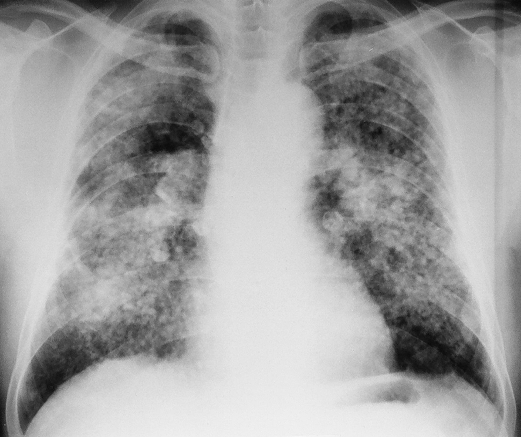 Пневмофиброз легких: что это такое и как его лечить pulmono.ru
пневмофиброз легких: что это такое и как его лечить