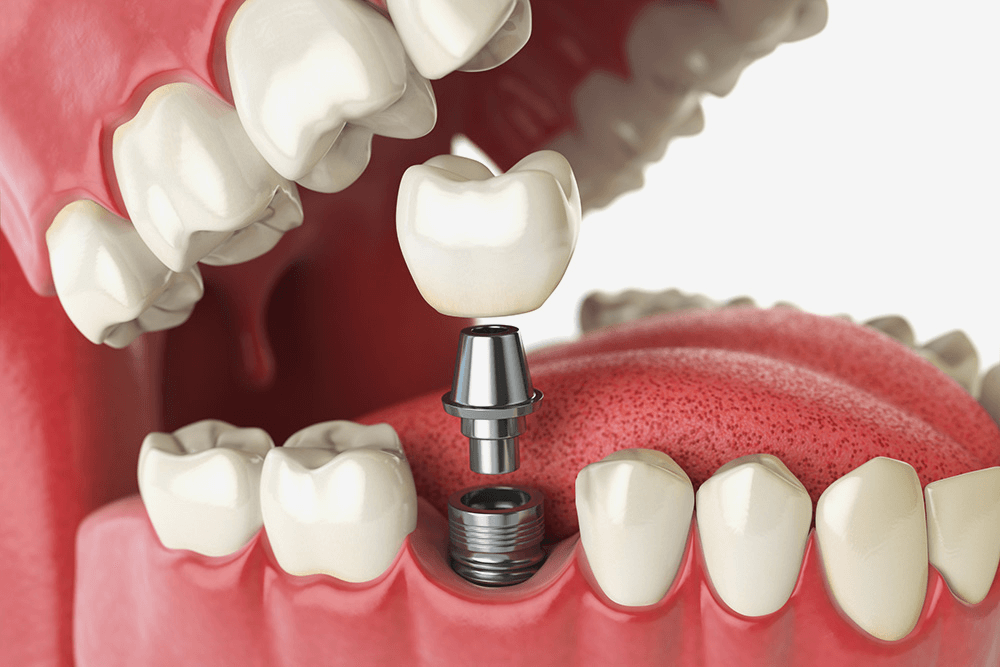 Одноэтапная имплантация зубов: новая улыбка за короткий срок