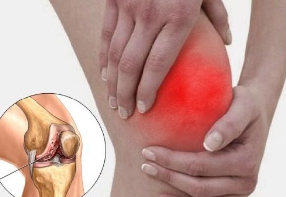 Синовит коленного сустава: симптомы, диагностика и лечение