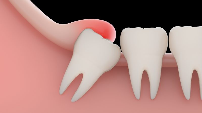 Симптомы роста зубов мудрости и способы облегчения процесса