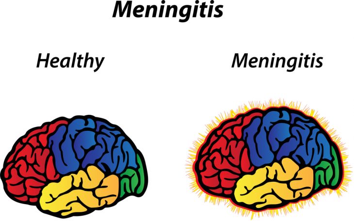 Опасное заболевание: признаки менингита у взрослых и детей, варианты лечения