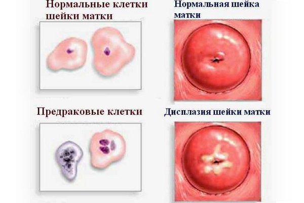 Дисплазия шейки матки - что это: лечение и степени заболевания