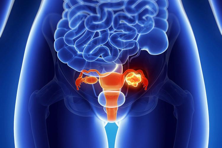 Ретенционная киста яичника у женщин: симптомы, причины развития, методы лечения