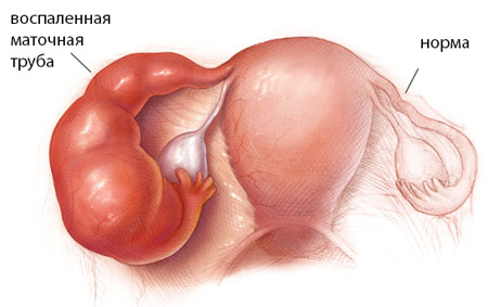Что такое гистерэктомия матки: методы гинекологического вмешательства