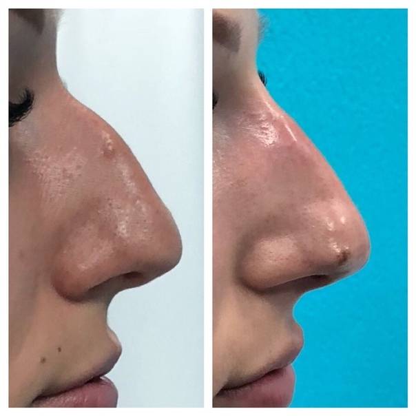 Ринопластика широкого носа
