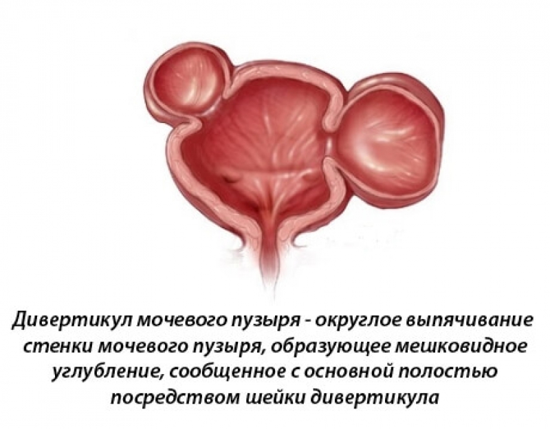 Дивертикул мочевого пузыря – опасное осложнение «мужских» болезней