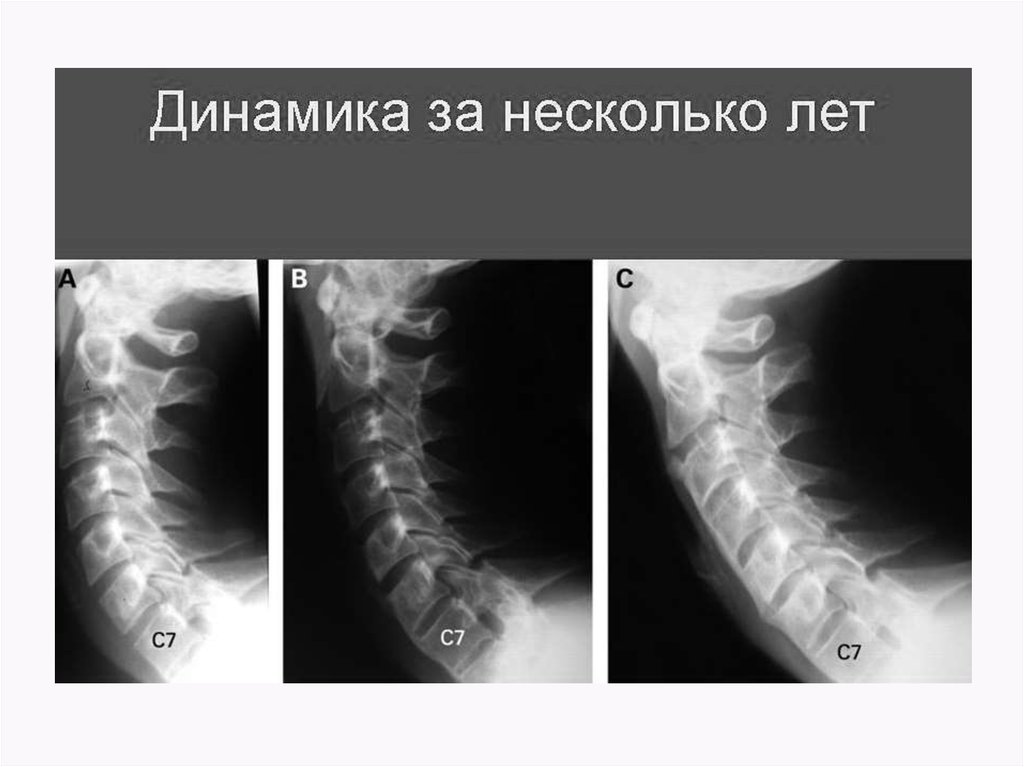 Анкилозирующий спондилит - симптомы, диагностика