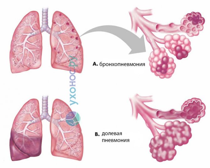 Тактика лечения двухсторонней полисегментарной пневмонии