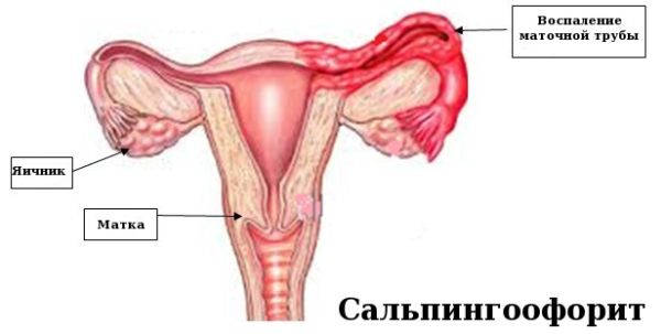 Сальпингоофорит у женщин: причины, симптомы, лечение