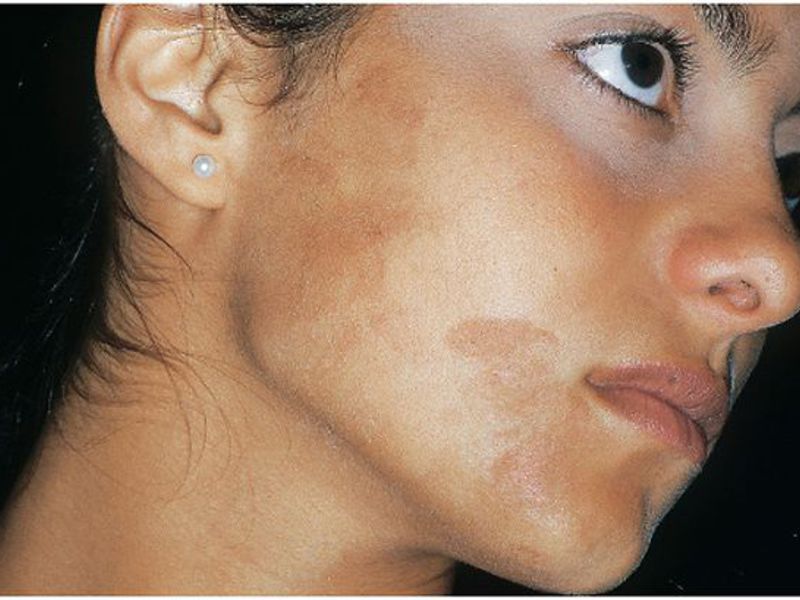 Пигментные пятна на лице: причины их появления и правильное лечение. ваша кожа вновь засияет!