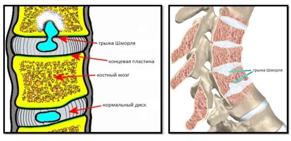 Грыжа шморля