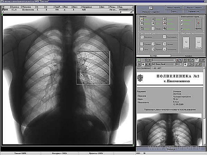 Результаты флюорографии: таблица расшифровки цифр и кодов, что значит норма в заключении и фото как выглядит снимок легких здорового человека