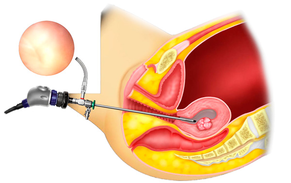 Гистерорезектоскопия полипа эндометрия: операция и послеоперационный период