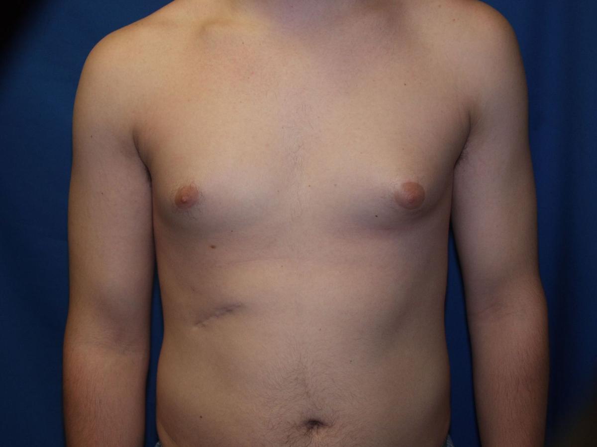 асимметрия груди у мужчин фото 52