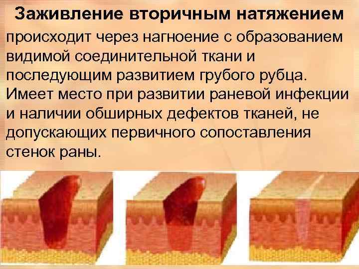 Грануляция раны фото