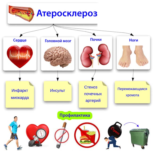 Атеросклероз - что это такое? симптомы, причины, диагностика и лечение.