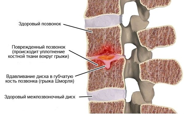 Грыжа шморля